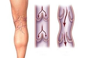 odtok krvi v kŕčových žilách v rôznych štádiách vývoja ochorenia